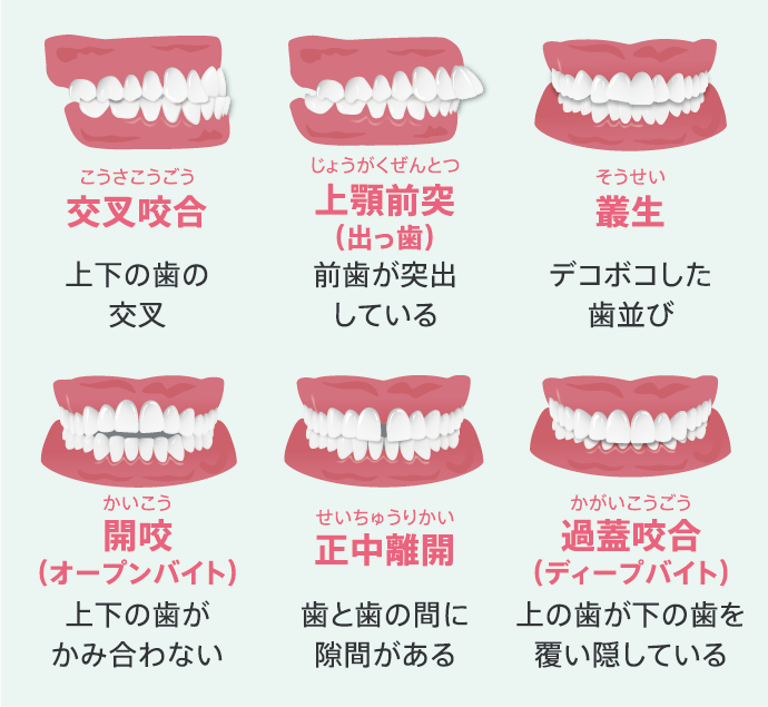 マウスピース矯正（アライナー矯正）の治療が受けられる症状について