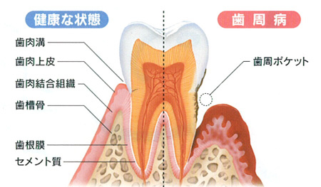 歯周病